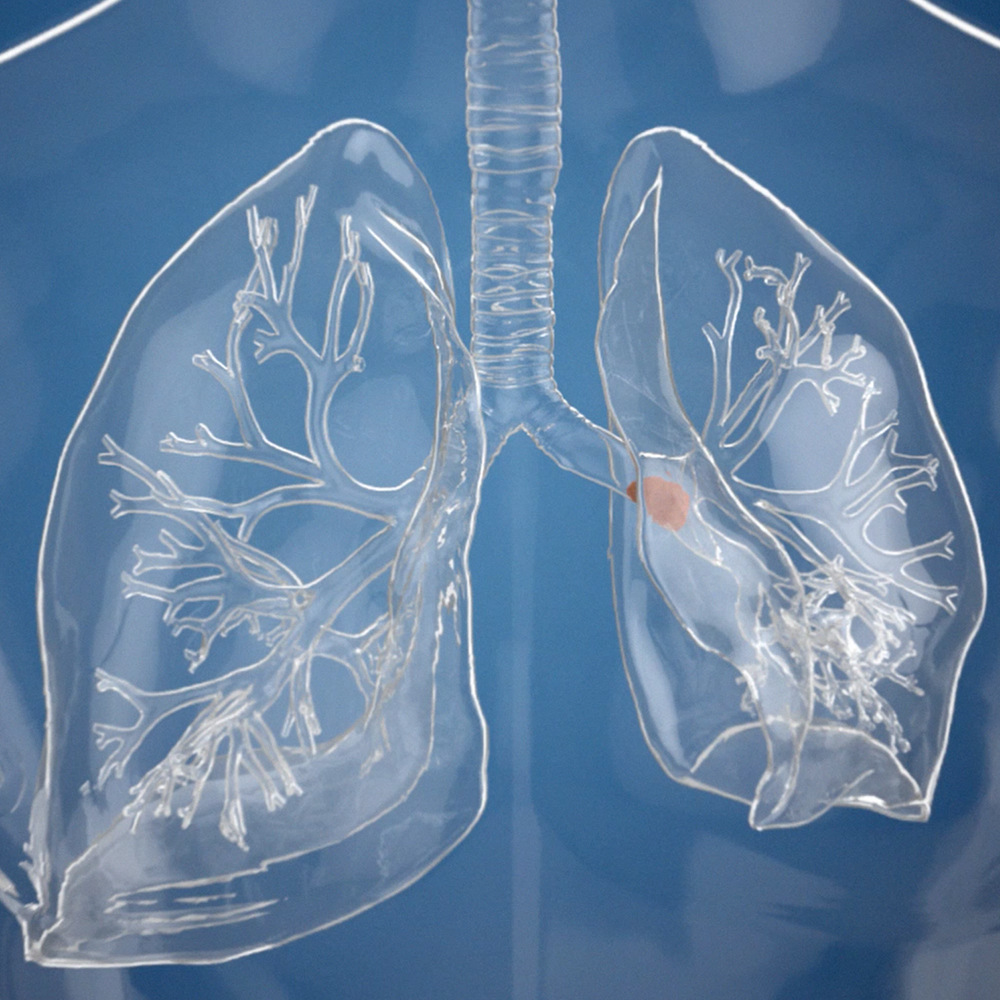 Transparent lungs with a lesion